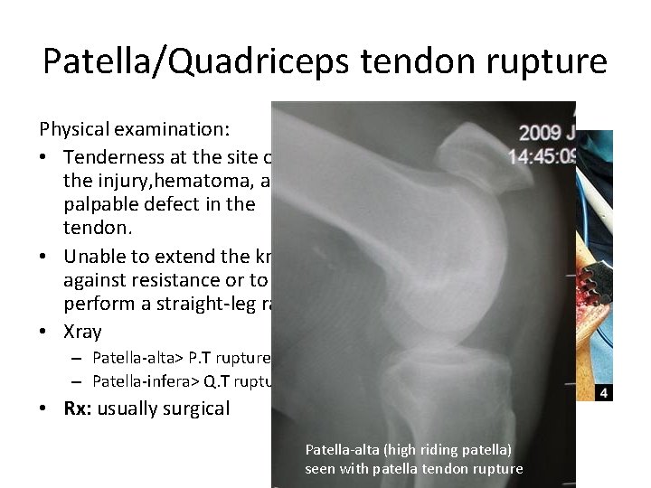 Patella/Quadriceps tendon rupture Physical examination: • Tenderness at the site of the injury, hematoma,