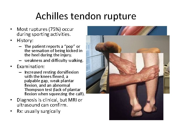 Achilles tendon rupture • Most ruptures (75%) occur during sporting activities. • History: –