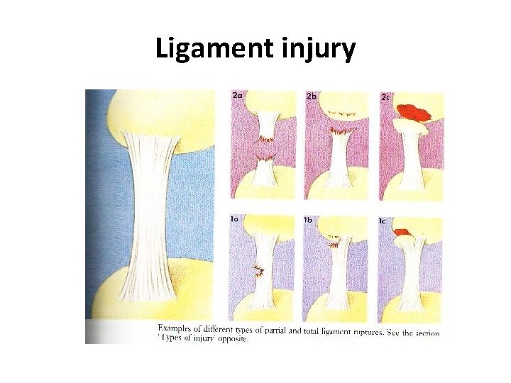 Ligament injury 