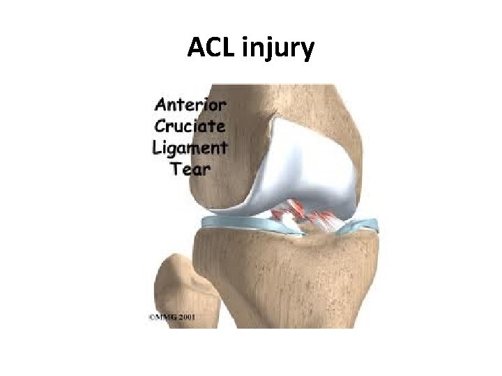 ACL injury 