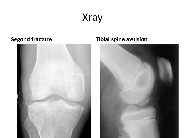 Xray Segond fracture Tibial spine avulsion 