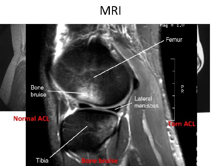 MRI Normal ACL Torn ACL Bone bruise 