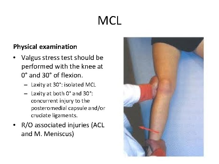 MCL Physical examination • Valgus stress test should be performed with the knee at