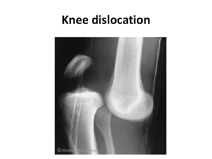 Knee dislocation 