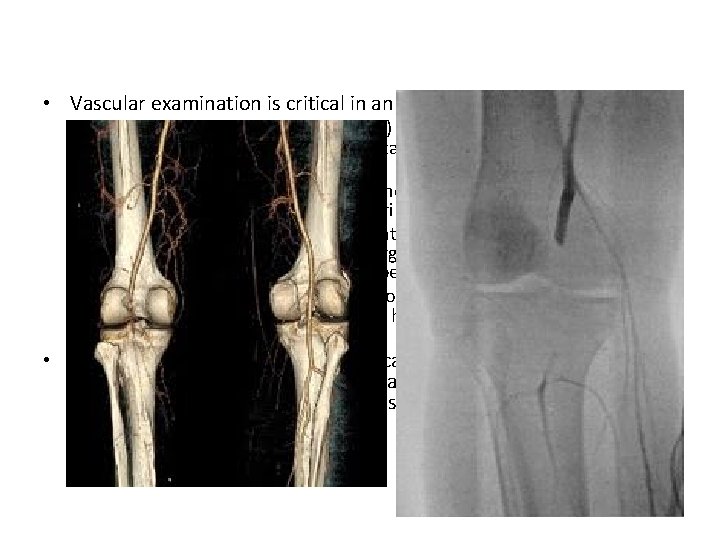  • Vascular examination is critical in an acutely dislocated knee. – Pulse and