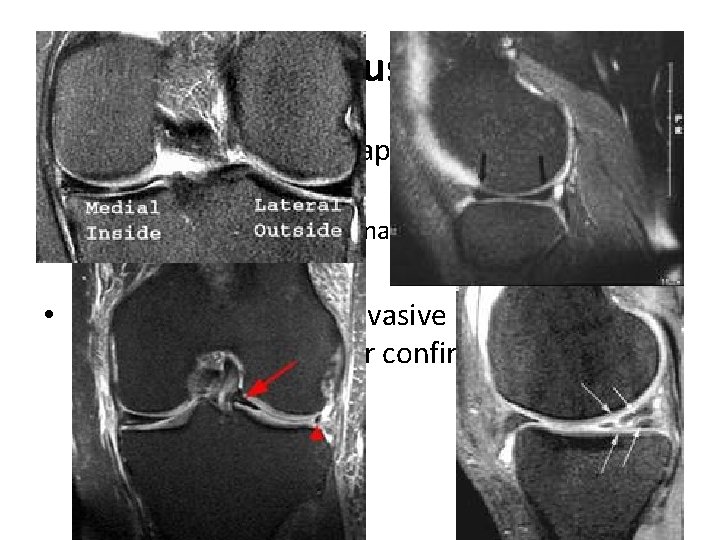 Meniscus tear • Standard knee radiographs should be obtained for evaluating for – Bone