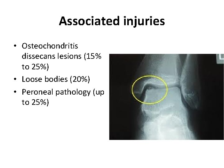 Associated injuries • Osteochondritis dissecans lesions (15% to 25%) • Loose bodies (20%) •