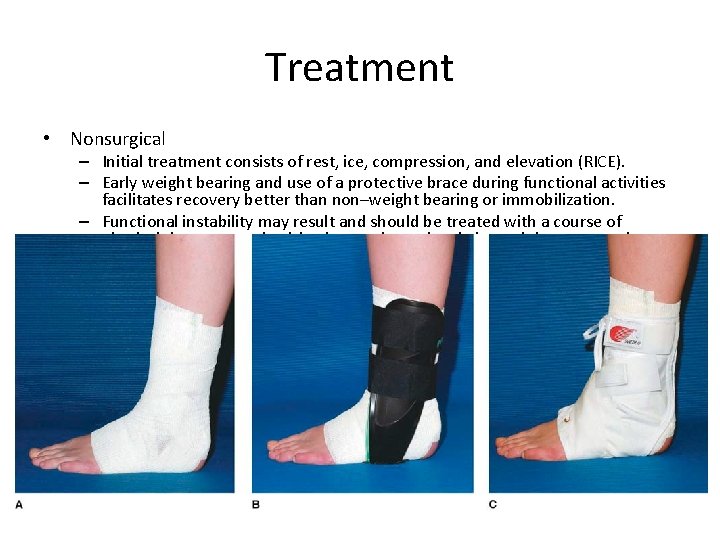 Treatment • Nonsurgical – Initial treatment consists of rest, ice, compression, and elevation (RICE).