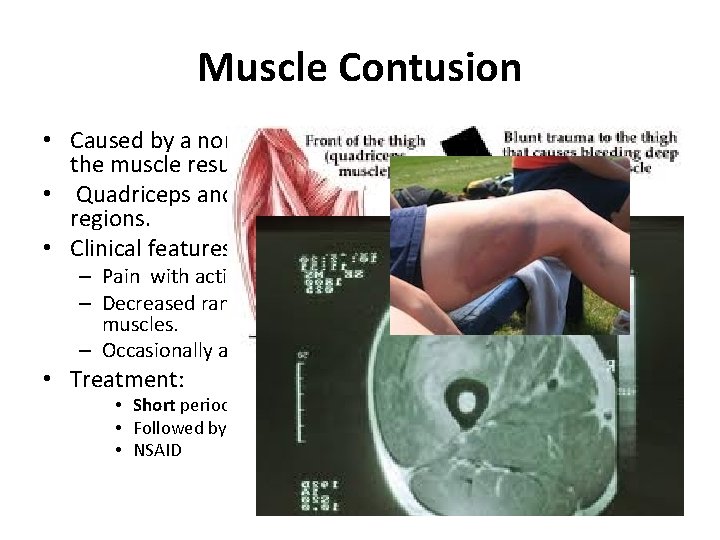 Muscle Contusion • Caused by a nonpenetrating blunt injury (direct blow) to the muscle