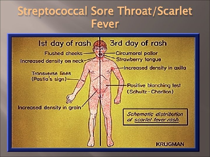 Streptococcal Sore Throat/Scarlet Fever 