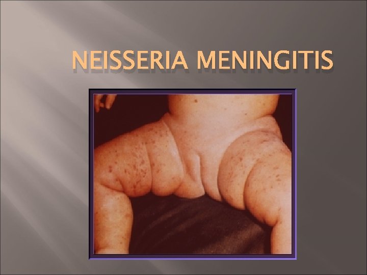 NEISSERIA MENINGITIS Meningococcemia 