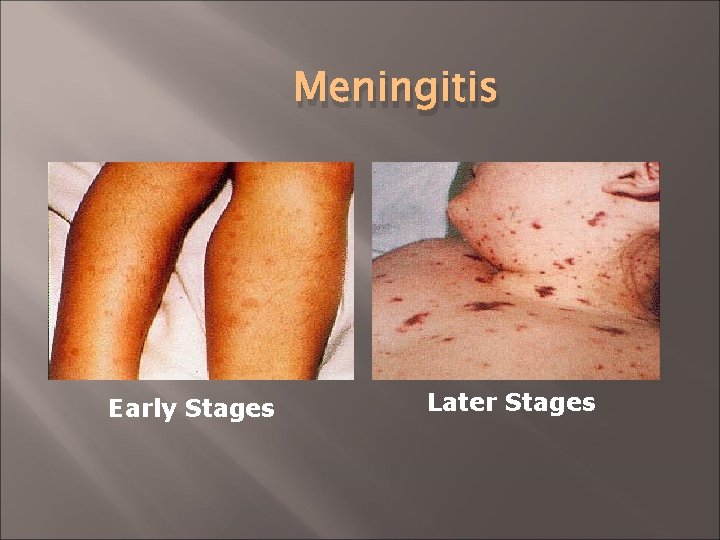 Meningitis Early Stages Later Stages 