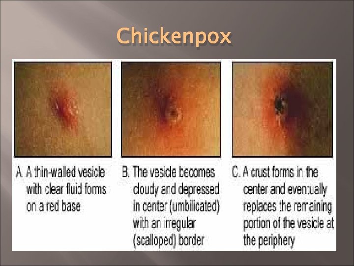 Chickenpox 