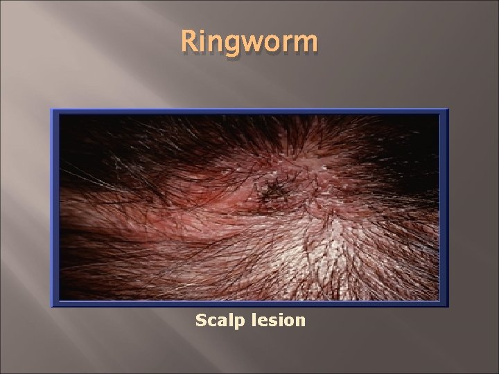 Ringworm Scalp lesion 