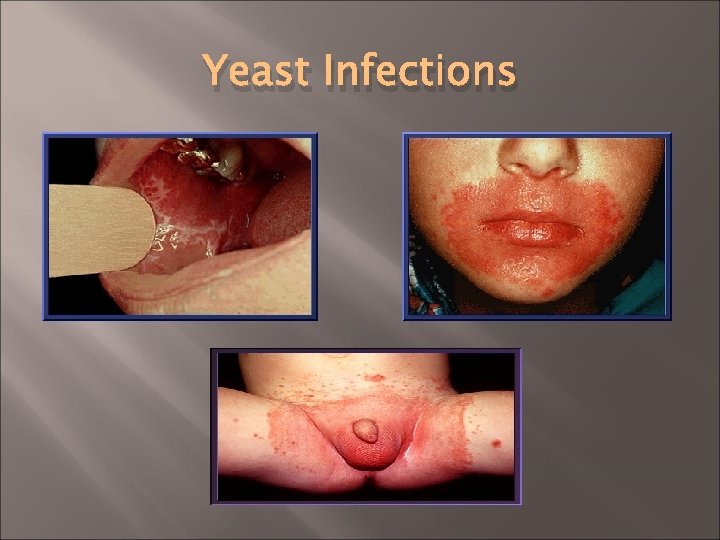 Yeast Infections 