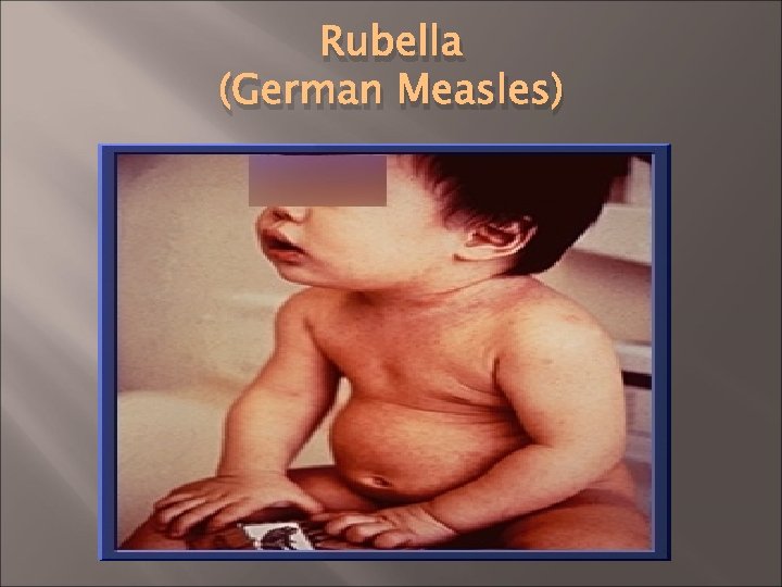 Rubella (German Measles) 
