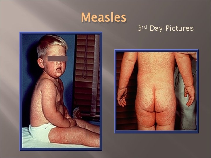 Measles 3 rd Day Pictures 