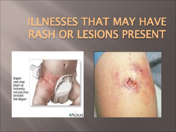 ILLNESSES THAT MAY HAVE RASH OR LESIONS PRESENT 