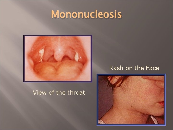 Mononucleosis Rash on the Face View of the throat 