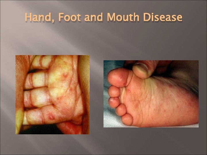 Hand, Foot and Mouth Disease 