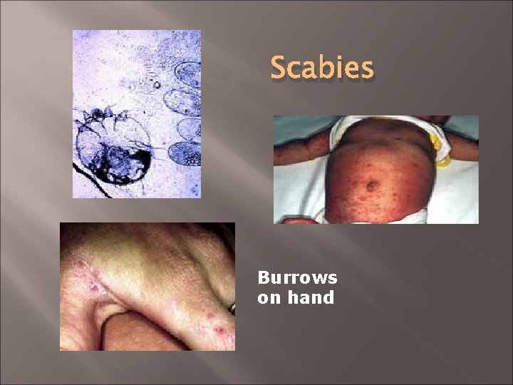 Scabies Burrows on hand 