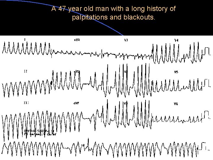 A 47 year old man with a long history of palpitations and blackouts. 