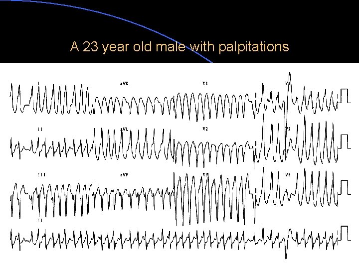 A 23 year old male with palpitations 