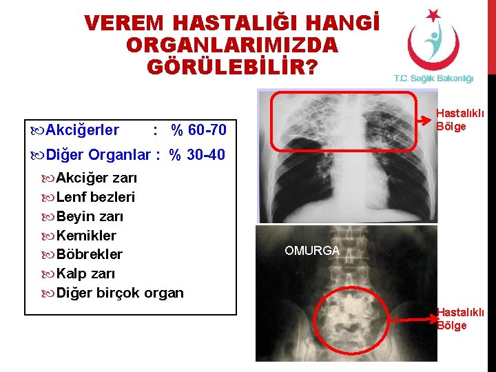 VEREM HASTALIĞI HANGİ ORGANLARIMIZDA GÖRÜLEBİLİR? Akciğerler Hastalıklı Bölge : % 60 -70 Diğer Organlar