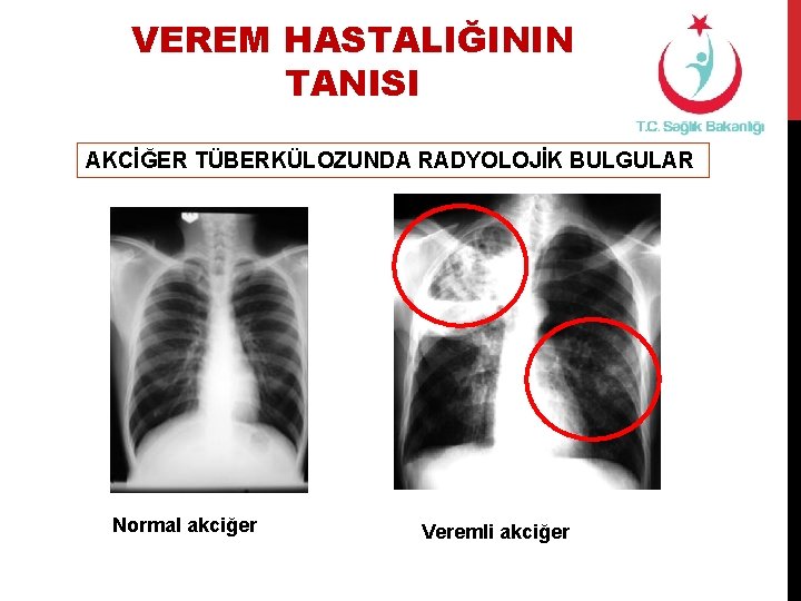 VEREM HASTALIĞININ TANISI AKCİĞER TÜBERKÜLOZUNDA RADYOLOJİK BULGULAR Normal akciğer Veremli akciğer 
