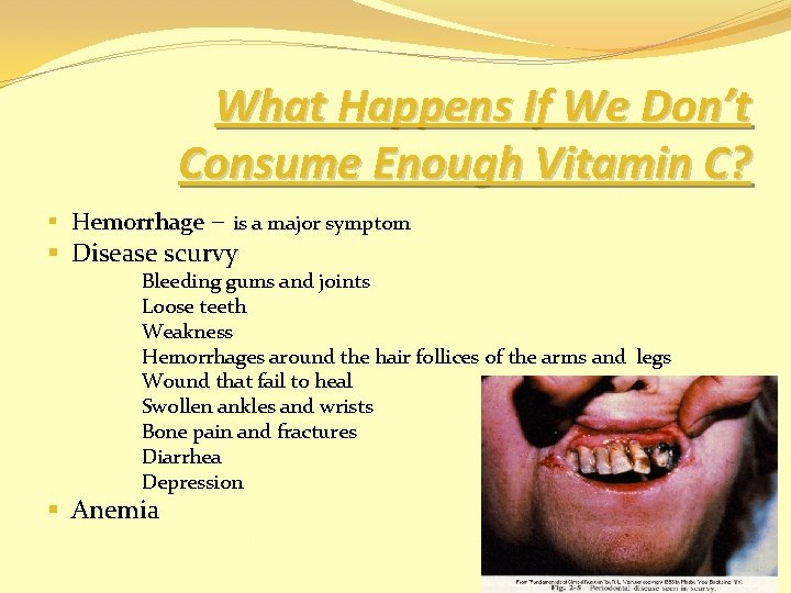 What Happens If We Don’t Consume Enough Vitamin C? § Hemorrhage – is a