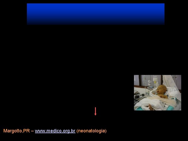 Margotto, PR – www. medico. org. br (neonatologia) 