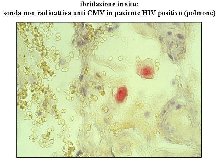 ibridazione in situ: sonda non radioattiva anti CMV in paziente HIV positivo (polmone) 