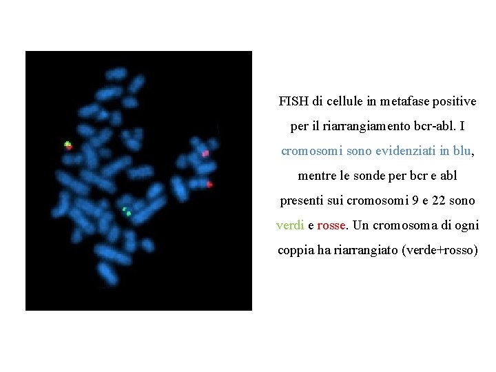 FISH di cellule in metafase positive per il riarrangiamento bcr-abl. I cromosomi sono evidenziati