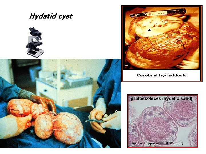 Hydatid cyst 