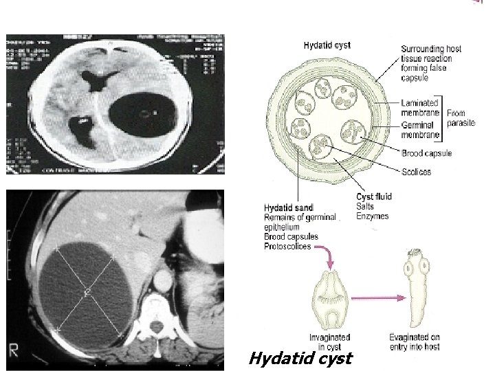 Hydatid cyst 