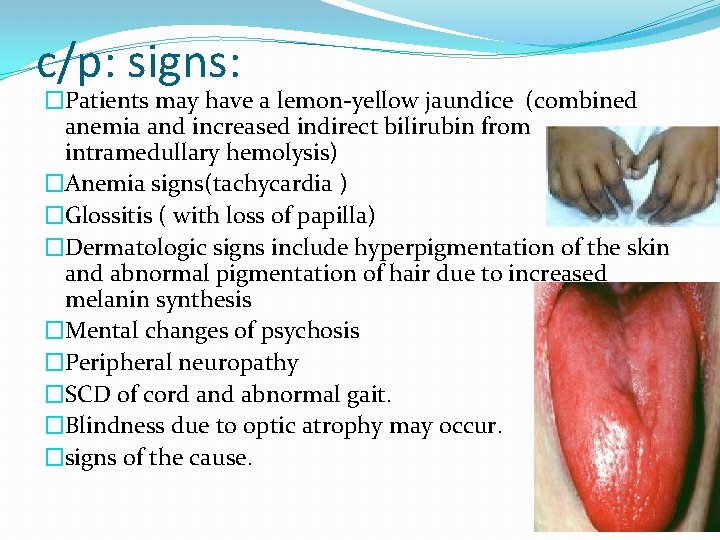 c/p: signs: �Patients may have a lemon-yellow jaundice (combined anemia and increased indirect bilirubin