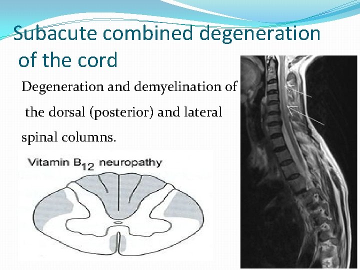 Subacute combined degeneration of the cord Degeneration and demyelination of the dorsal (posterior) and