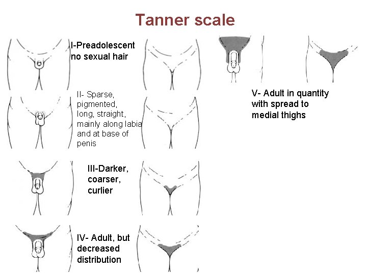 Tanner scale I-Preadolescent no sexual hair II- Sparse, pigmented, long, straight, mainly along labia