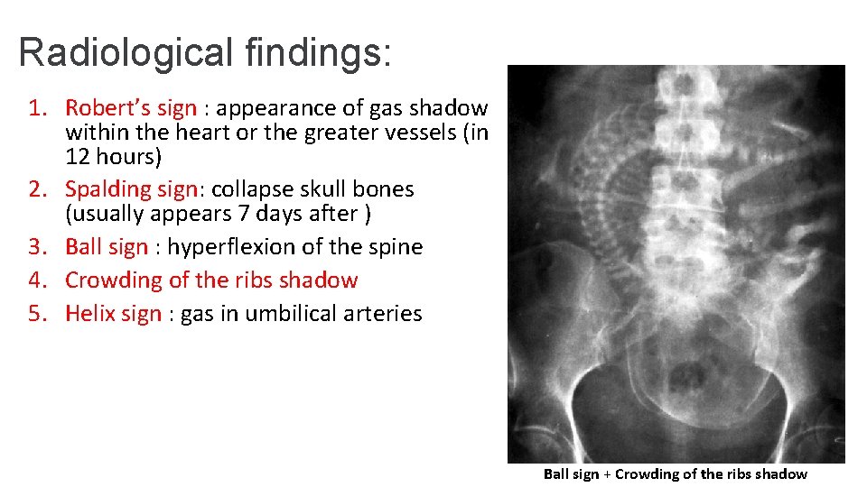 Radiological findings: 1. Robert’s sign : appearance of gas shadow within the heart or