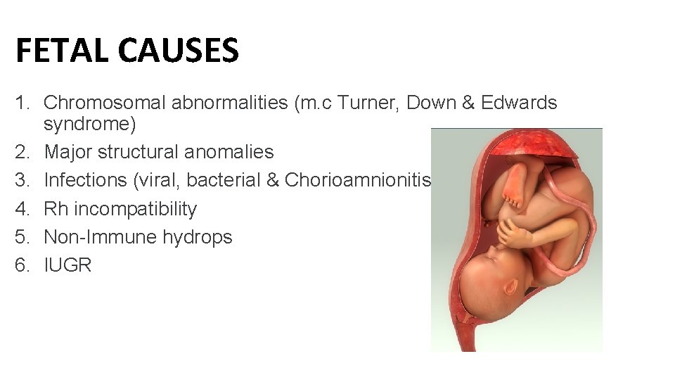 FETAL CAUSES 1. Chromosomal abnormalities (m. c Turner, Down & Edwards syndrome) 2. Major