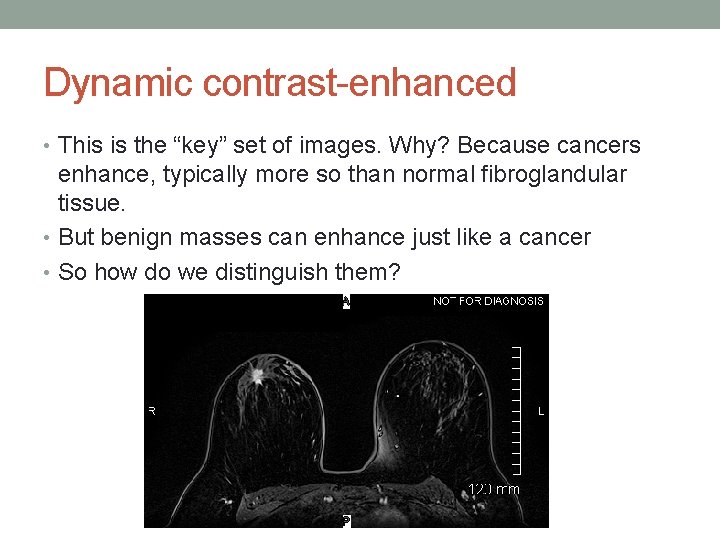 Dynamic contrast-enhanced • This is the “key” set of images. Why? Because cancers enhance,
