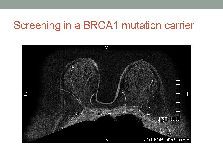 Screening in a BRCA 1 mutation carrier 