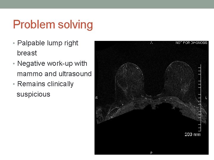 Problem solving • Palpable lump right breast • Negative work-up with mammo and ultrasound