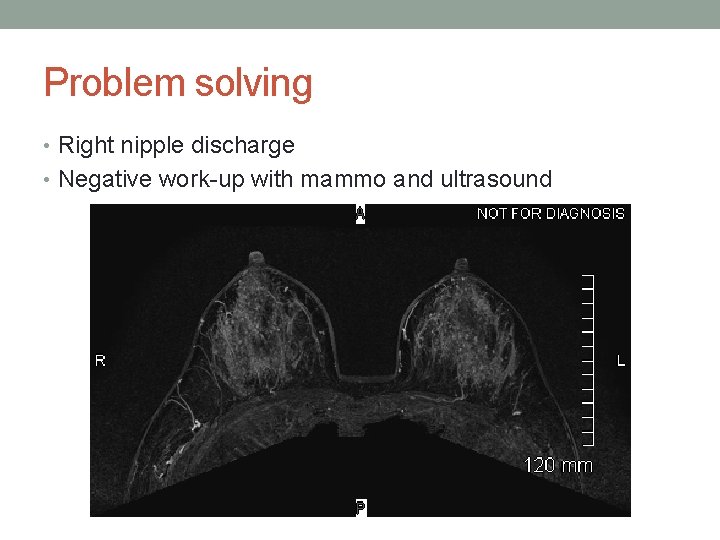 Problem solving • Right nipple discharge • Negative work-up with mammo and ultrasound 