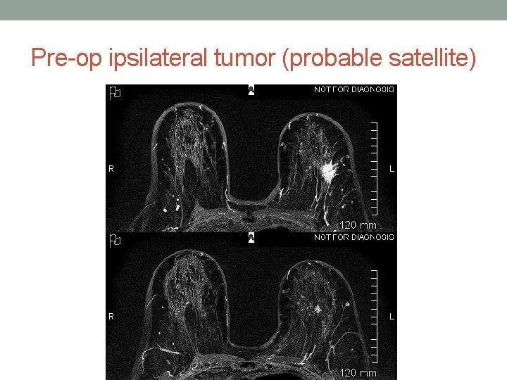 Pre-op ipsilateral tumor (probable satellite) 