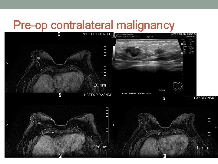 Pre-op contralateral malignancy 