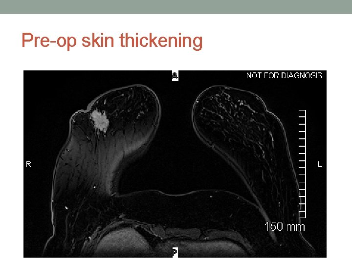 Pre-op skin thickening 