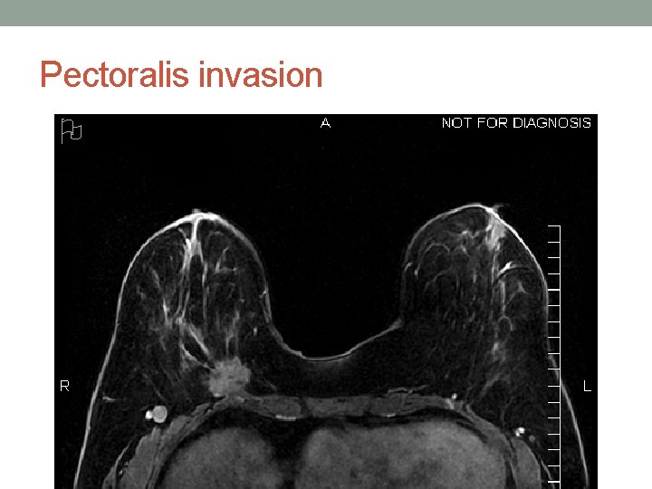 Pectoralis invasion 