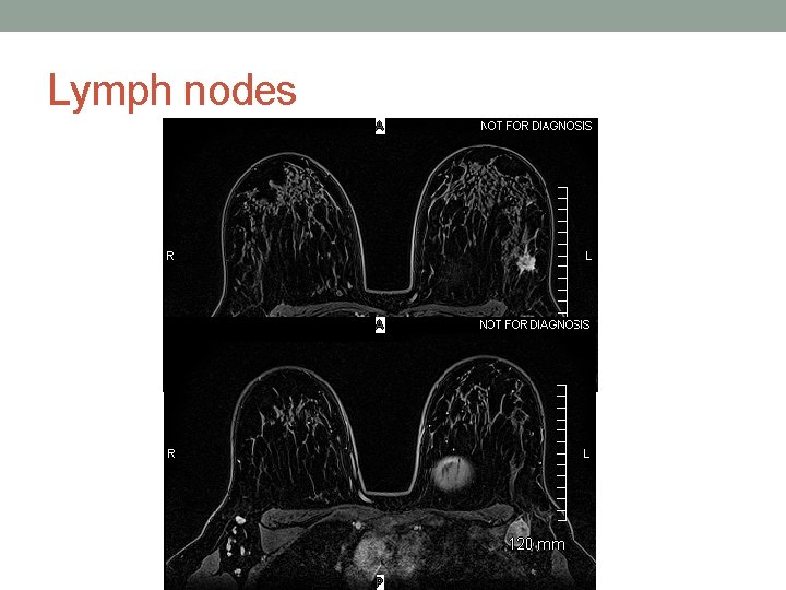 Lymph nodes 