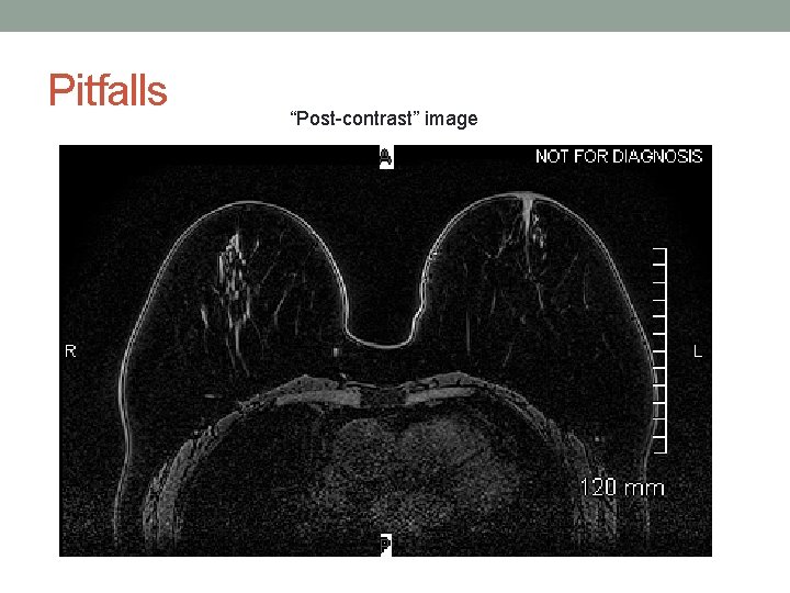 Pitfalls “Post-contrast” image 